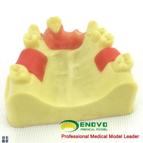 ENOVO颐诺上颌缺失种植实x训模型口腔即刻种植操作上颌骨缺失牙齿