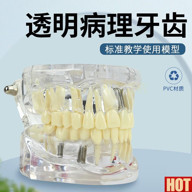 理口腔模型 牙齿模型模具早教刷牙牙模k标准教具牙医讲解模型
