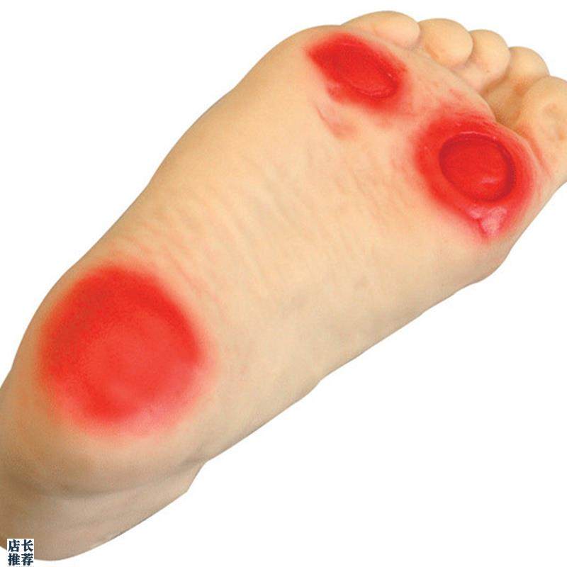 正品高级糖尿病足护理模型足部病变护理T模型畸形脚模具