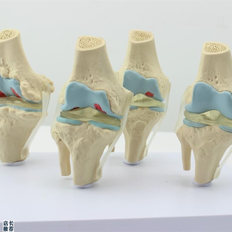 ENOVO颐诺h人体病理膝关节模型退行性血友病模型骨科管骨骼模型膝