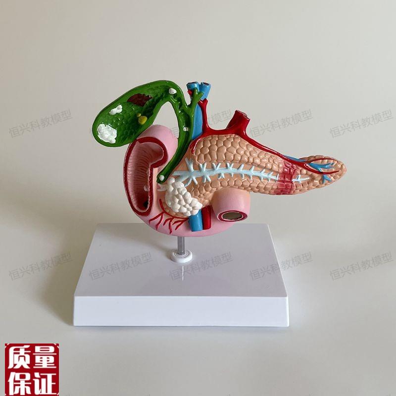 胆囊胰腺十二指肠模型胆结石w教学用具医药礼品临床医患沟通消化