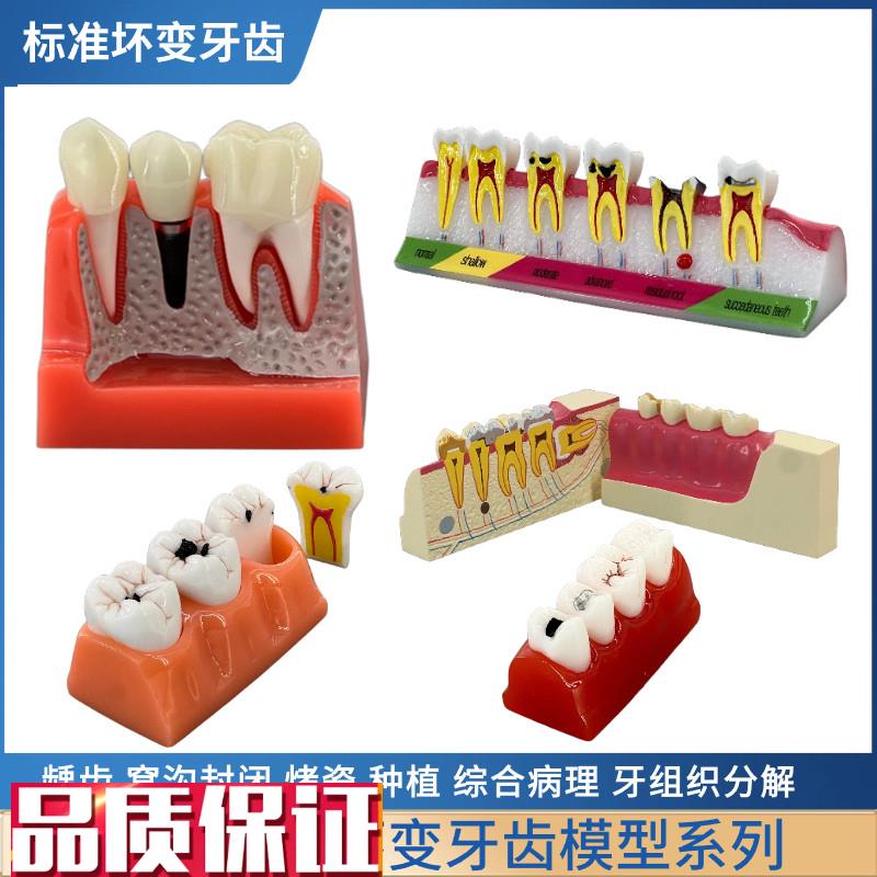 牙齿模型牙科口腔模型龋齿对比4C倍龋齿分解2倍牙齿发展演变蛀牙