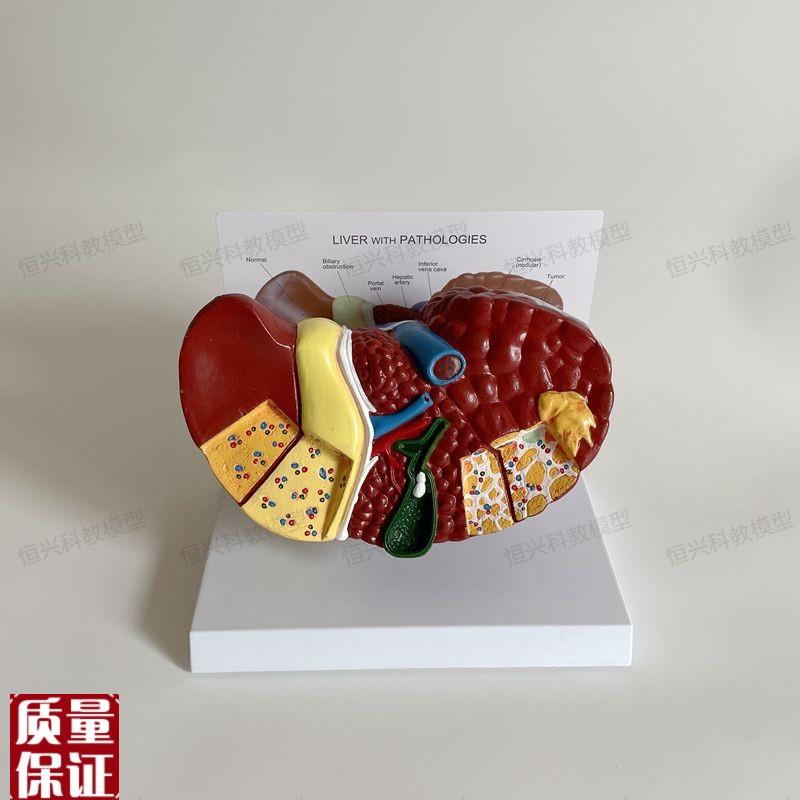 病理肝脏模型f胆硬化癌变临床医患酒精肝胆管分布人体肝脏解剖胆