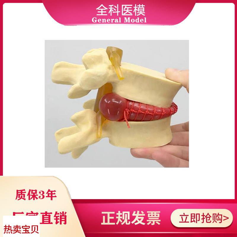 腰椎间盘突出模型