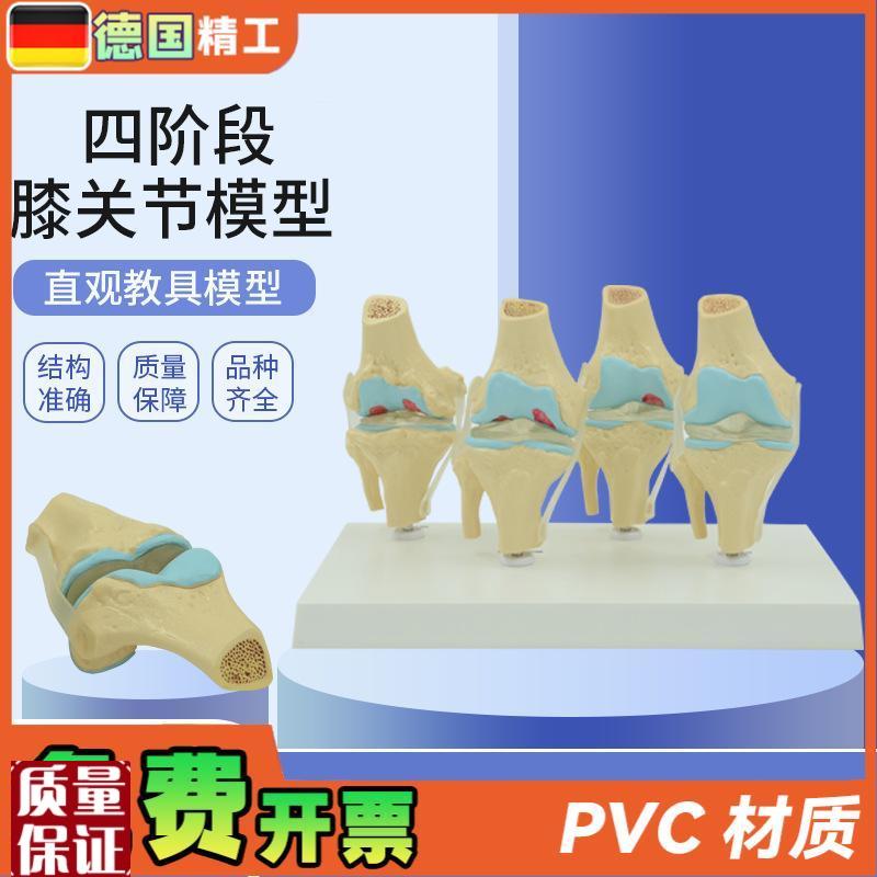 德国】人体c膝关节模型正常与病理对比教具医药礼品医患沟通道