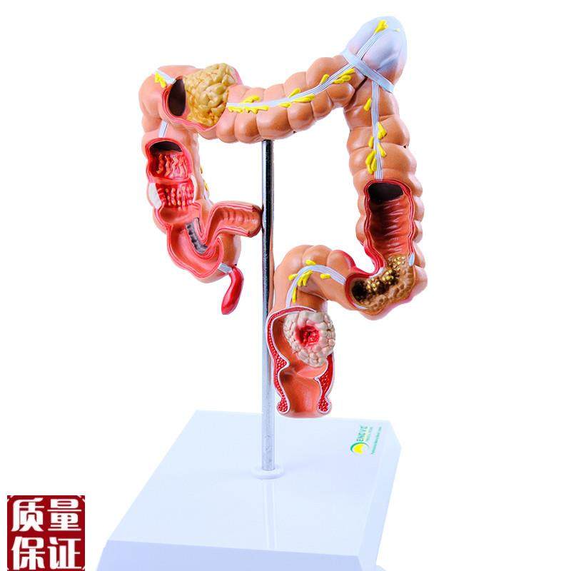 ENOVO颐诺h人体大肠疾病展示模型结肠直肠道病变症状消化系统疾