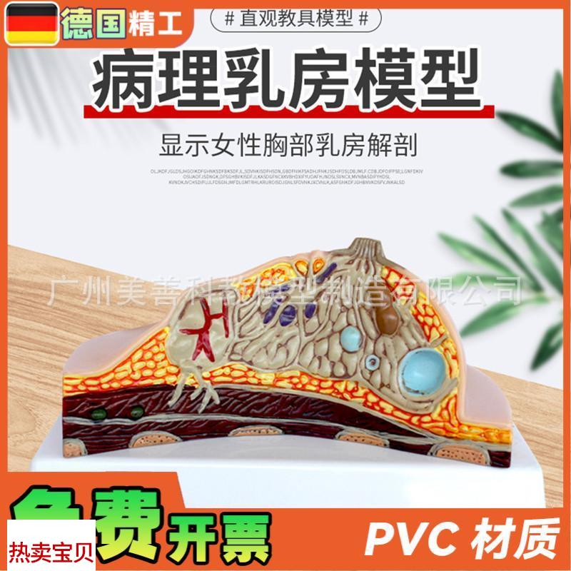 病理乳房模型乳房病变模型乳房解剖模型乳房常T见疾病乳房模型