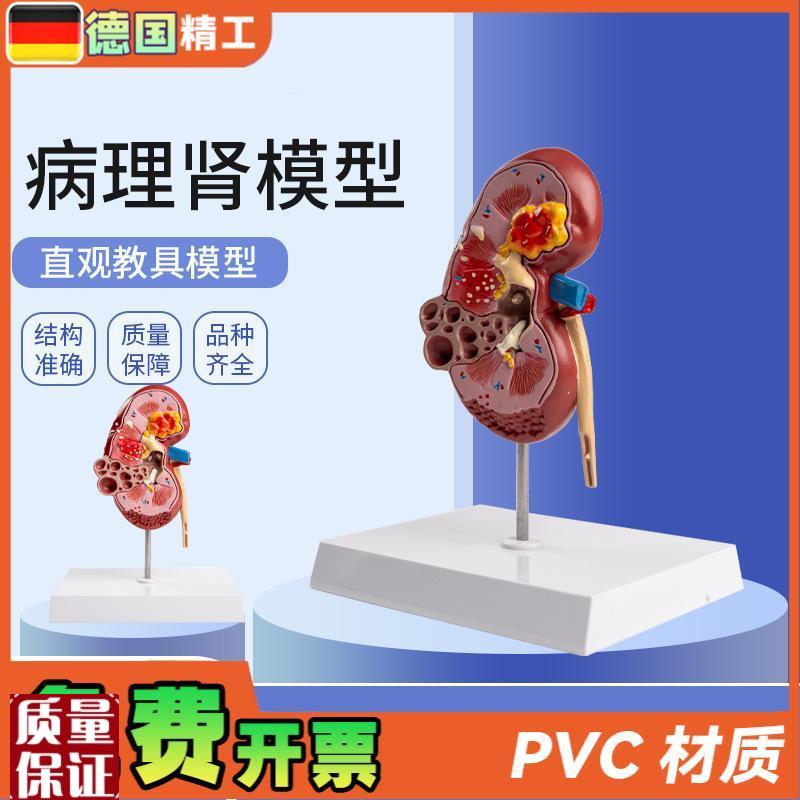 德国】病理肾模型肾脏模t型人体内脏模型自然大肾解剖附肾上腺
