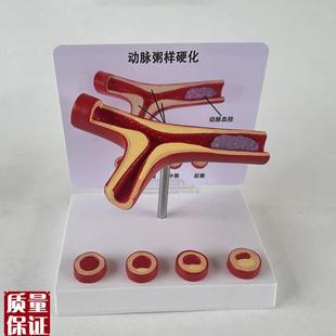 人体血管模型动脉血管结构冠状动脉健康J深静脉栓子临床医患血液