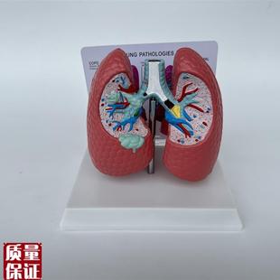 人体肺部病理g解剖展示模型医用教学医患讲解肺泡解剖气管咽炎病