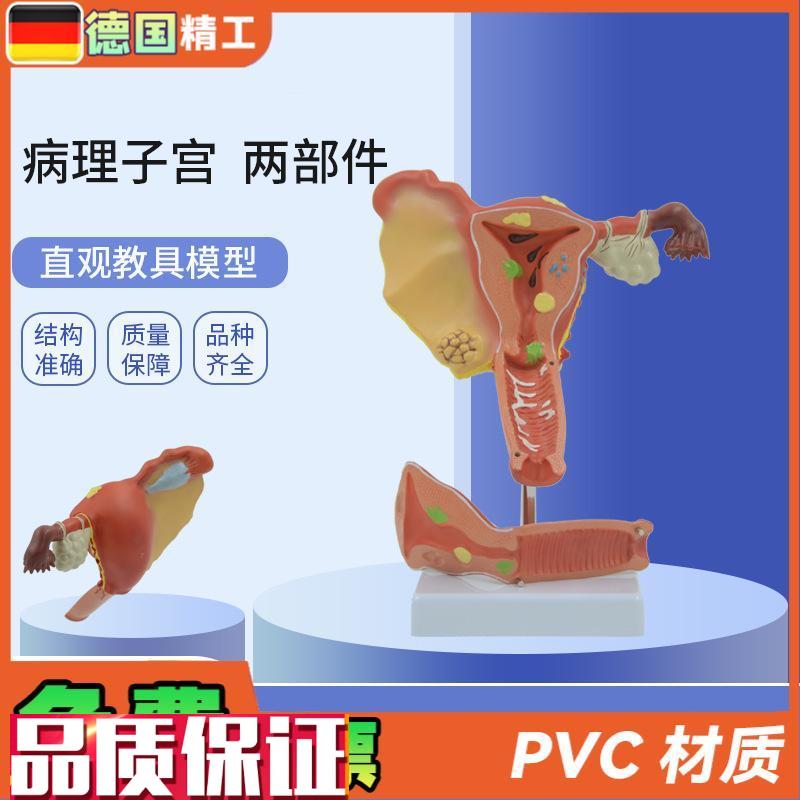 德国】PNT-0743仿真子宫模型病理子宫输卵管结构病态Z子宫模型教