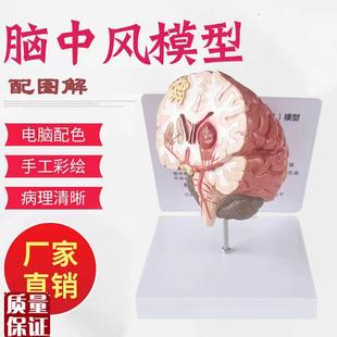 人体脑部疾病模型脑瘀血管大脑解剖中风脑M梗神经外科神经内科模