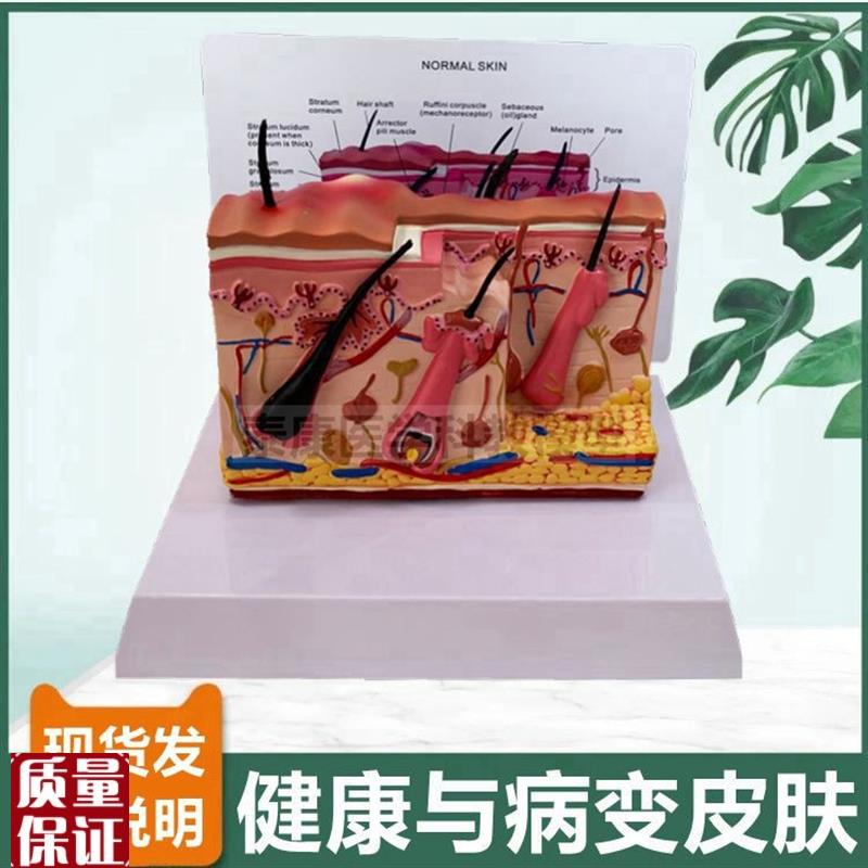 皮肤痤疮模型病理临床医患沟通人体E皮肤解剖螨虫叮咬受损医美整