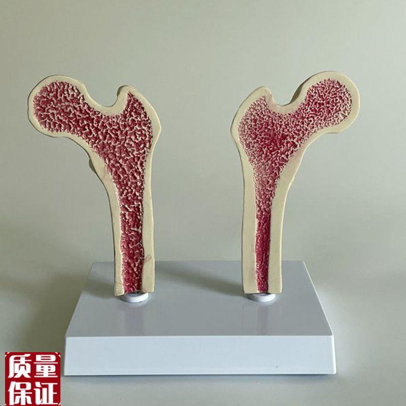 骨质疏松模型股骨头骨髓密度变化骨F科医药促销年龄段脊椎病理医