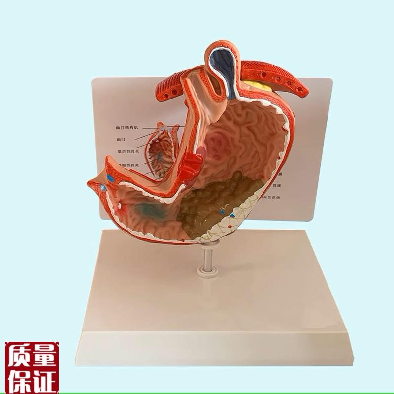 胃模型医学生教学食n管隔膜疝粘膜病理胃消化系统内脏医药促销教