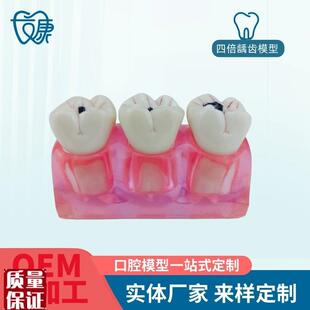 牙模型牙b科口腔教学模型窝沟封闭模型龋齿对比模型龋齿模