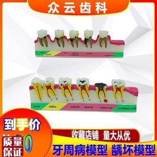 牙齿牙科牙周分类龋坏模型v变重过程牙科口腔医患沟通展示模型包
