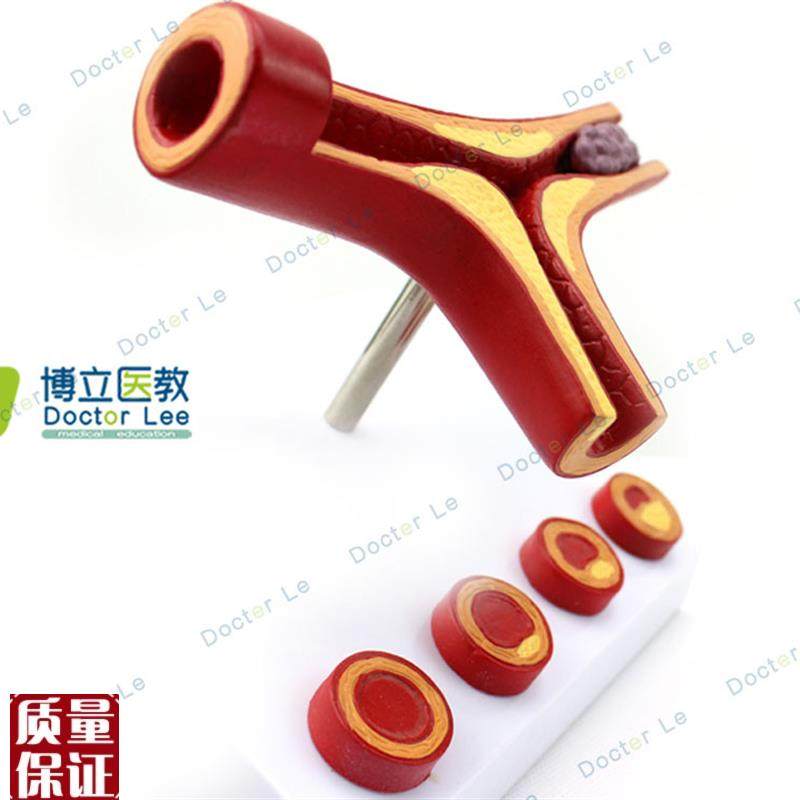 人体支脉粥e样化和血全形成模型血管模型人体血管解剖模