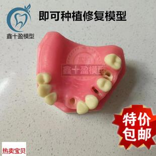 口腔种植练习模型上颌骨上颌窦牙列缺失F种植体齿科牙齿模型PIM-2