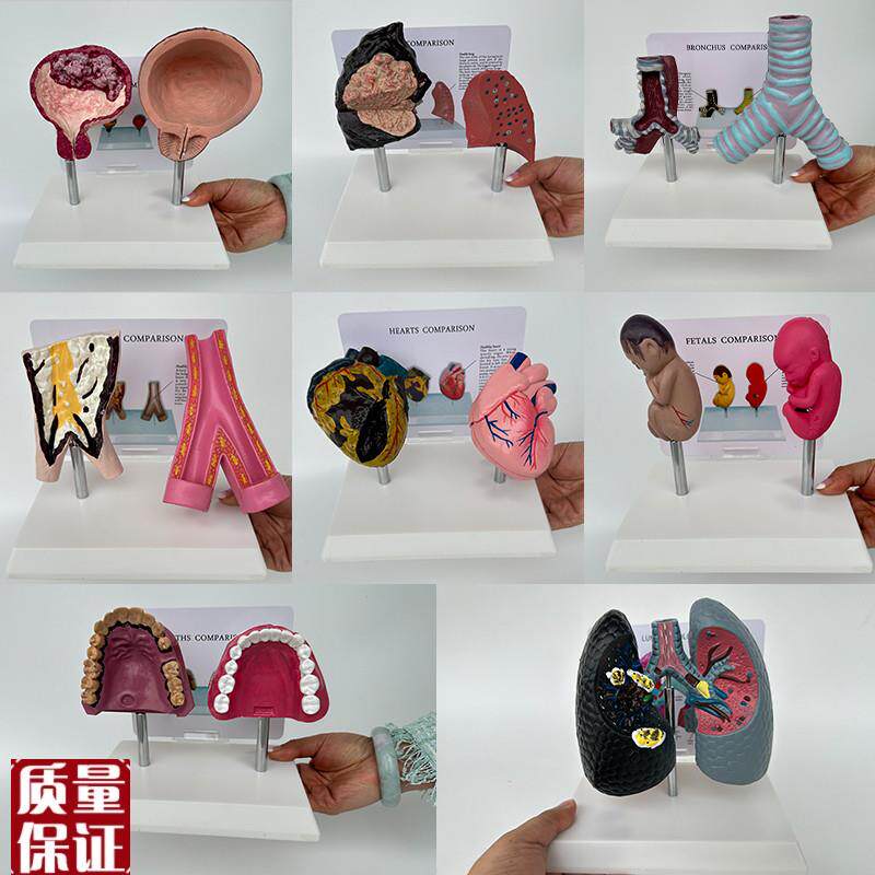 人体正常c内脏吸烟病变器官对比心肺部膀胱血管口腔气管胎医用模