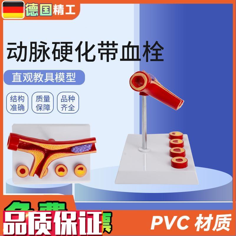 德国】动脉带血栓模型5部件血B管堵4塞血管粥样血管病理解剖