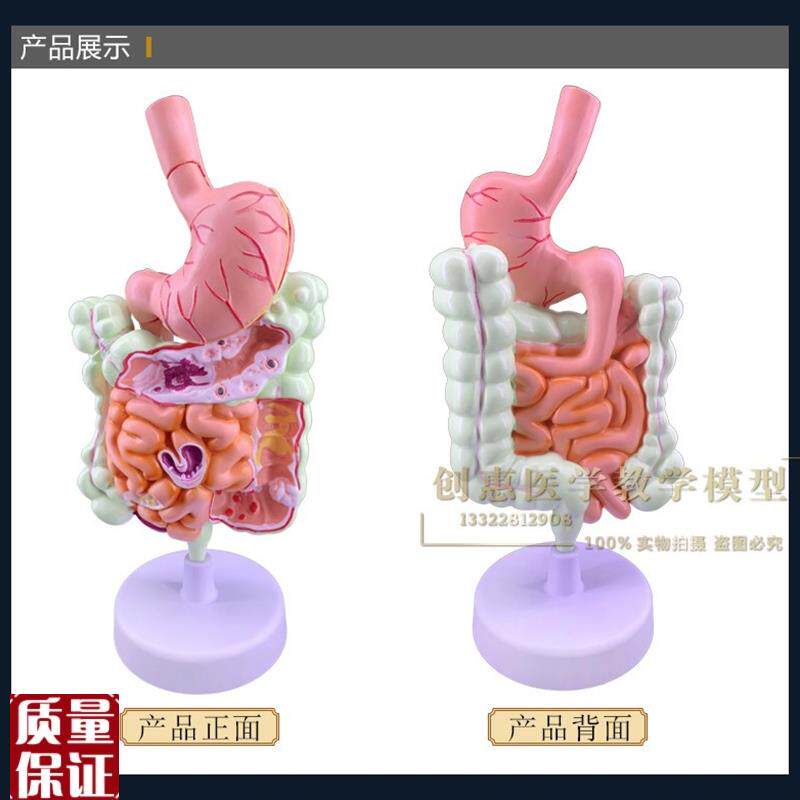教学结肠病理模型大肠病变标本肠道医患沟O通交流人体器官解剖包