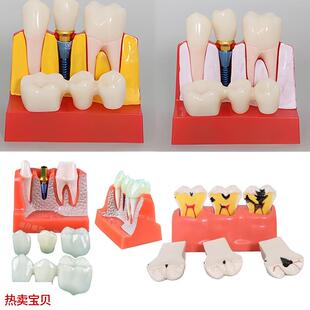 4次种植及解说模型l口腔牙齿模型牙冠可移动种植钉展示模型医学通