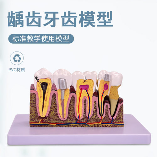牙科口腔6倍综合病理模型 人体龋齿解剖K根管及牙神经展示教学模
