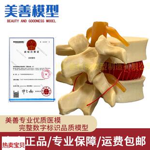 脊柱模型脊椎骨头腰椎间盘模具椎体模型突出受压Y病理骨质教具