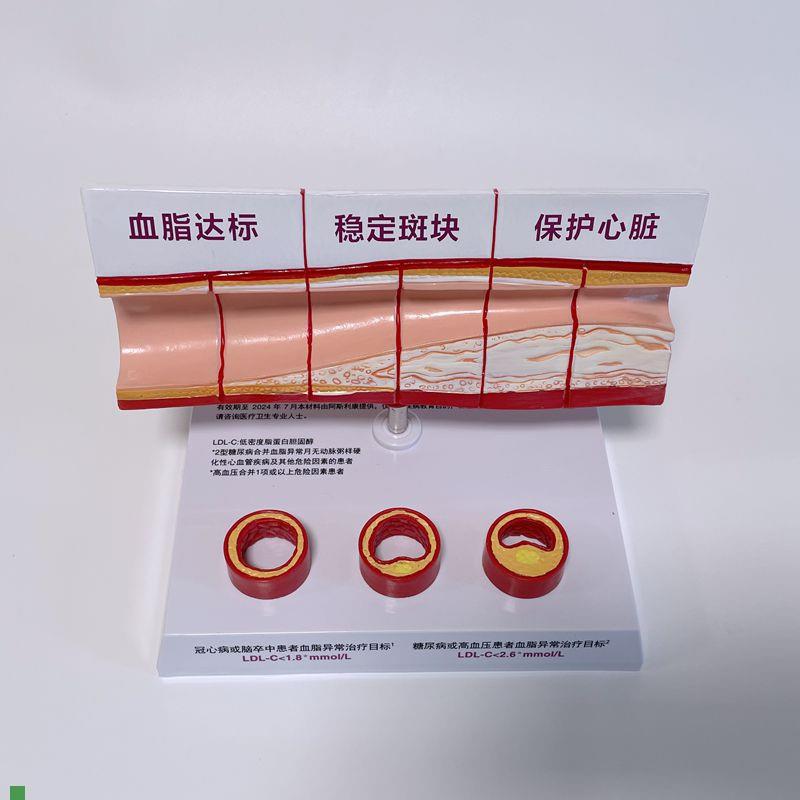 病理心血管模型粥样硬化脂肪斑块动脉内膜O受损程度医药促销礼品