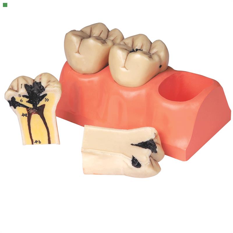 龋齿分解模型B10009