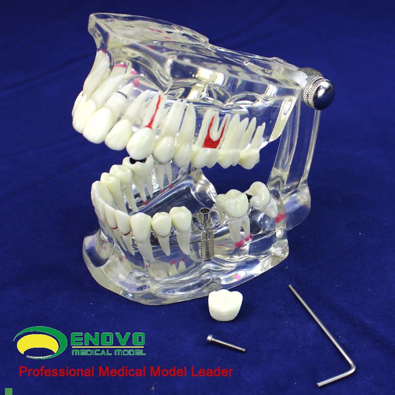 ENOVO颐诺牙齿模o型口腔牙齿科种植模型口腔病理模型种植体牙冠义