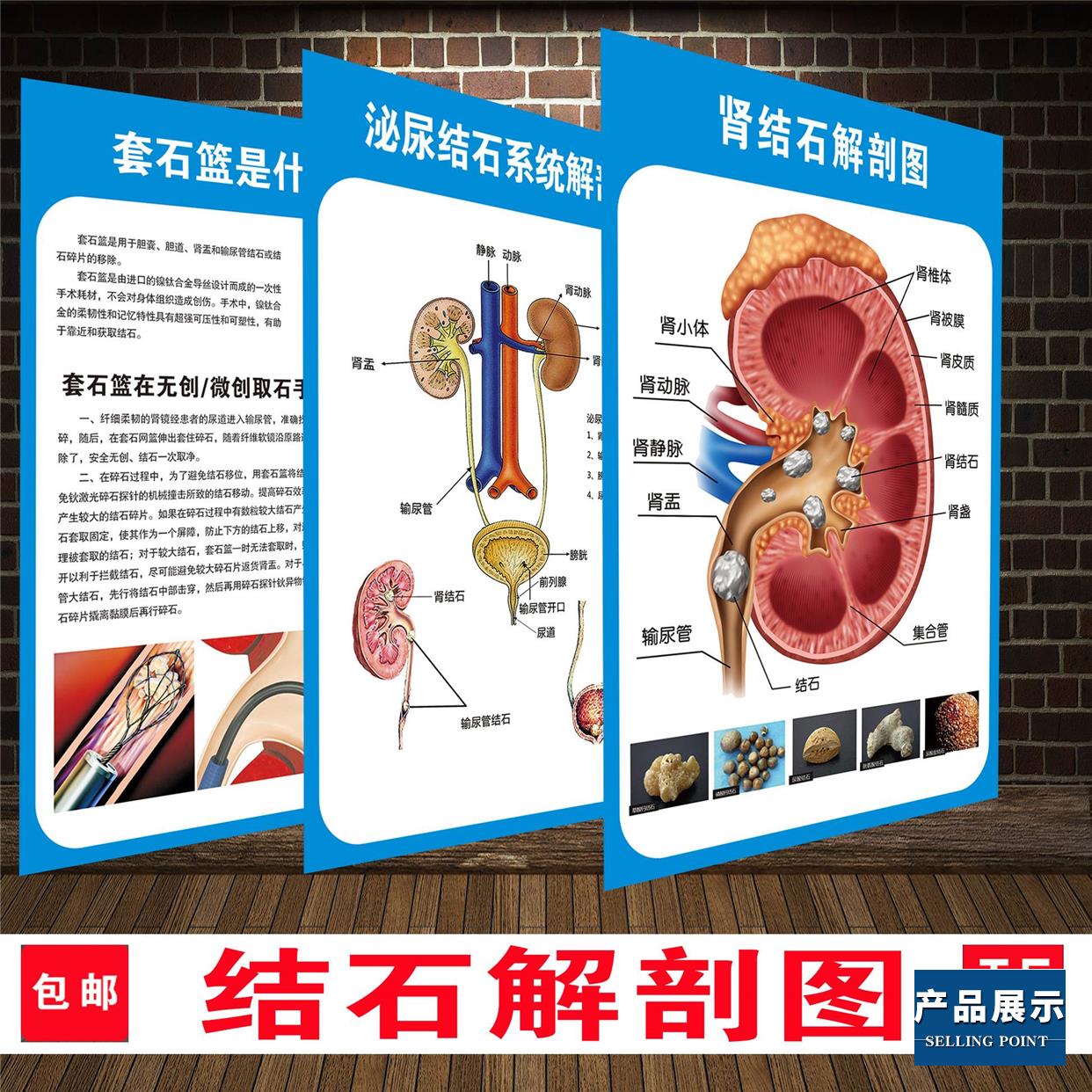 肾结石泌尿结石解剖图医学宣传挂图人体器官结构图医院海报墙贴纸