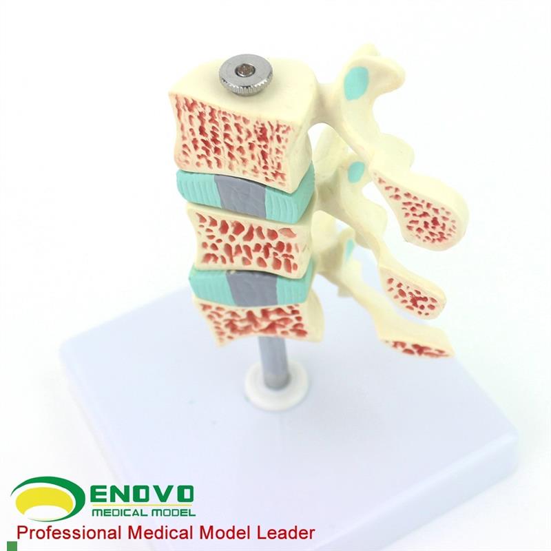ENOVOd颐诺人体骨质疏松症模型关节骨质疏松模型人体椎间盘腰椎模