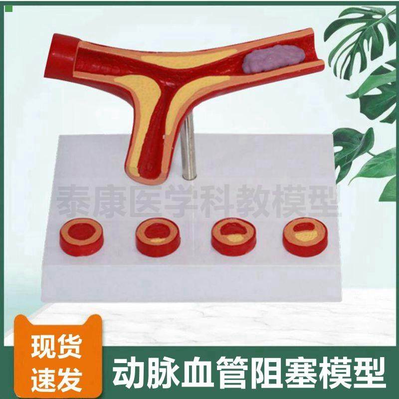动脉血管模型脂肪斑块粥样阻塞栓子硬化血压升高内膜变化医患沟通