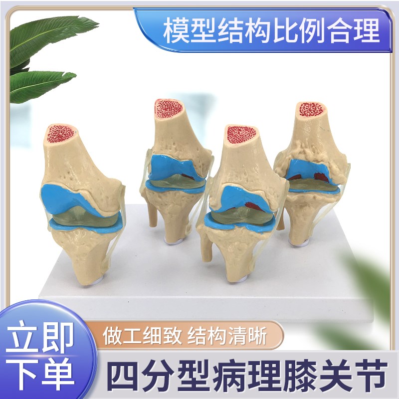 病理膝关节模型 病变膝q关节退行性 人体膝关节模型关节镜手术沟