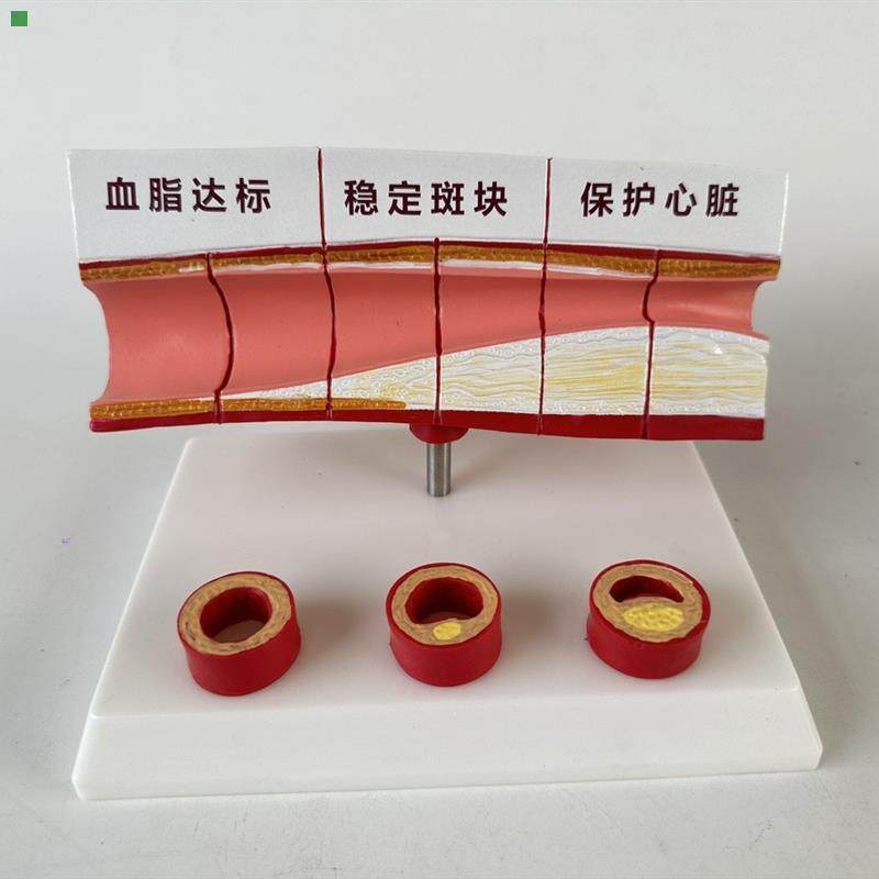 血管/堵塞动支脉粥样/硬化心血管动脉/ 硬化模型血管病理模型血栓
