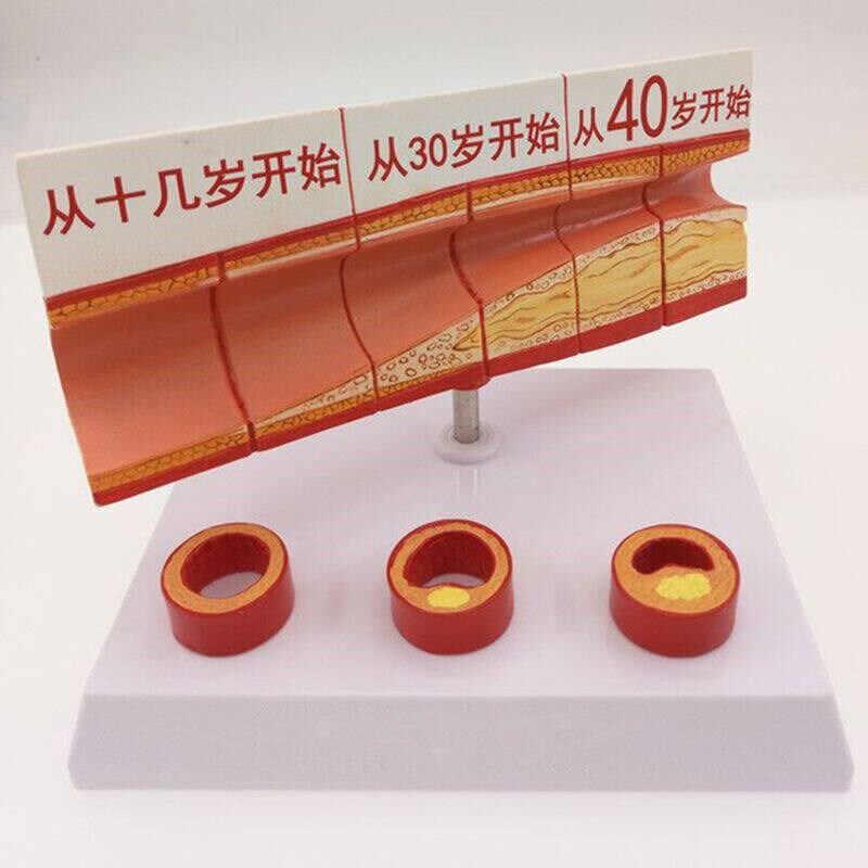 动脉血管b模型 不同年龄段血管内膜变化粥样硬化栓子血管狭窄斑块