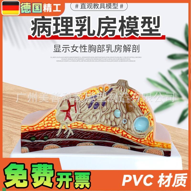 病理乳房模型乳房病变模型乳房解剖模型乳房S常见疾病乳房模型