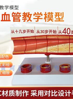血栓模型 人体支脉粥样 硬化动脉心血管 各阶段年U龄血管展示模型