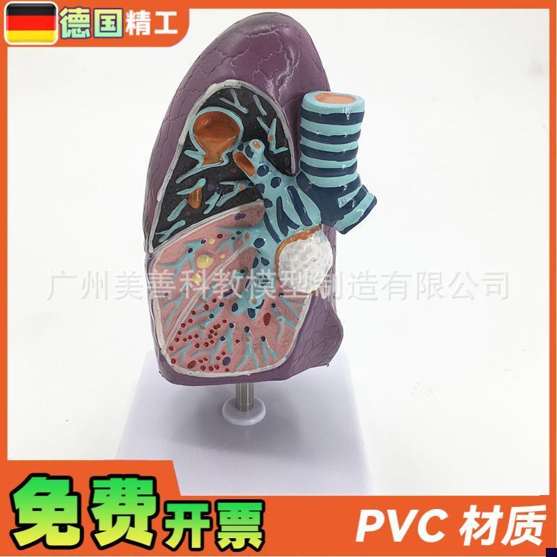 人体肺模型 病理肺解n剖模型 呼吸系统 人体脏器模型 病变肺模型