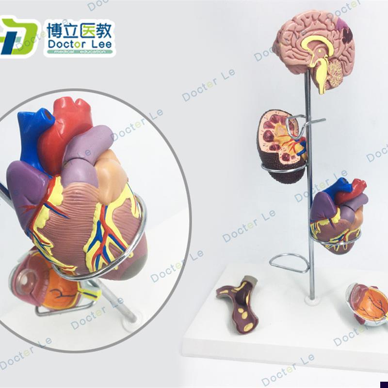 人体高血 c压模型 高 血 压大脑心脏血管内科普外科医生礼品 大脑