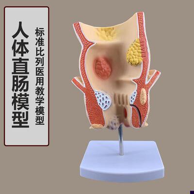 痔疮直肠病理g模型 溃杨性结肠病 肠直肠解剖病理模型病态疾病教