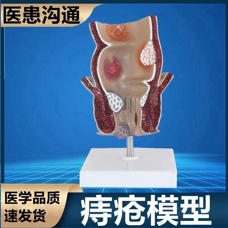 痔疮模型肛肠科医生o用医患沟通肛周钢管病理结肠大肠消化系统肠