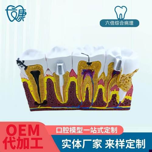 综合病理模型成人牙周 r切面牙齿模型 病理牙神经口腔牙科教学摆