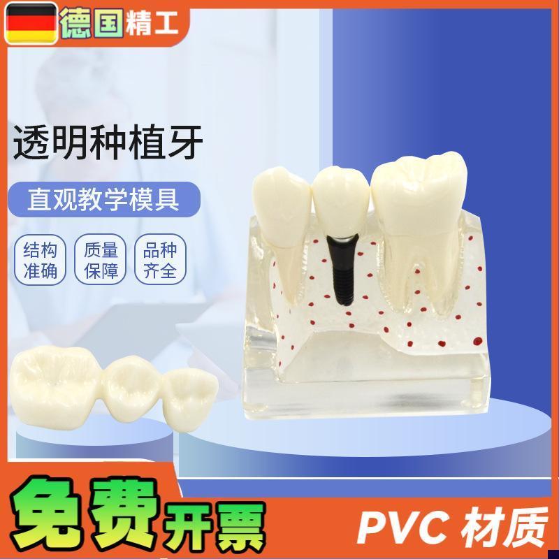 德国】透明种植牙模型p 牙科修复模型 透明可拆卸病理种植体牙
