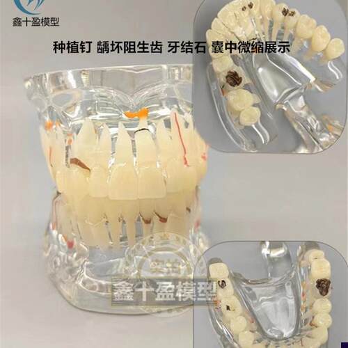 牙科牙齿模型 i2倍透明牙体综合病理模型 口腔科病理模型医患模型