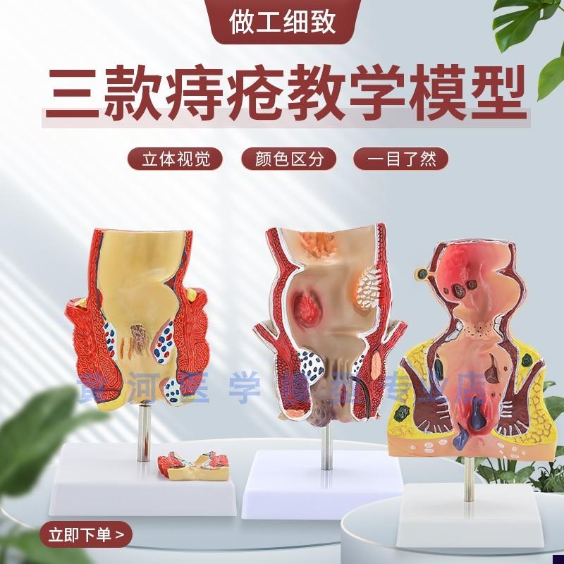 直肠痔疮大肠结肠病变模型 内外C直肠痔疮肛门肛肠科模型直肠病理