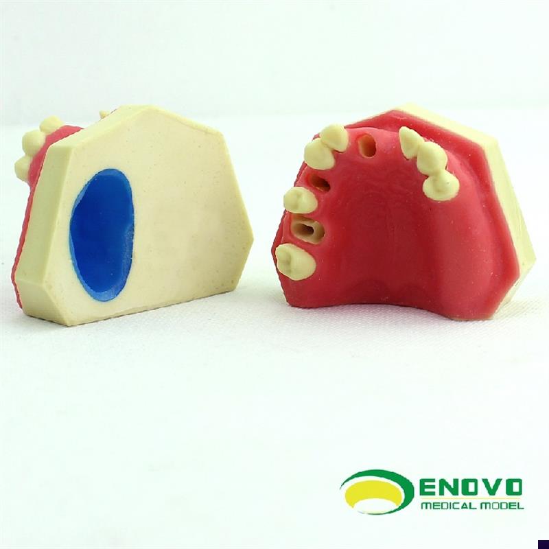 ENOVO颐诺口腔即刻种植练习操B作模型上颌骨上颌窦牙列缺失种植体