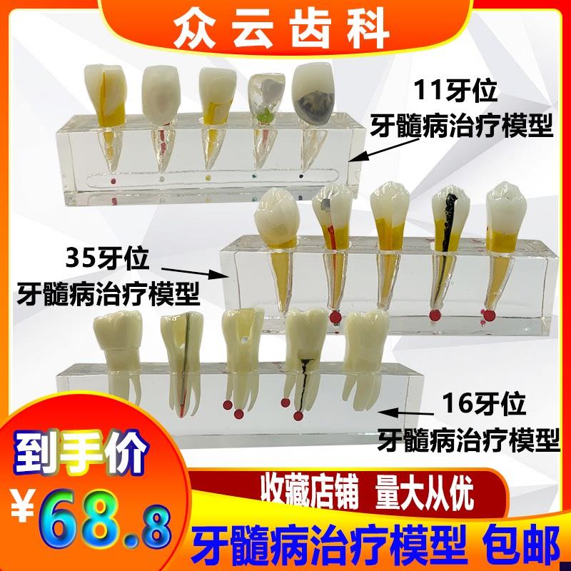 牙科口腔牙髓病治疗模型解剖前磨牙E龋坏牙冠髓腔充填可拆牙列模